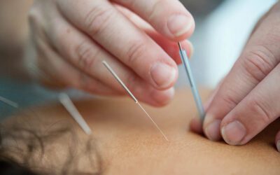 Wat is Dry Needling?