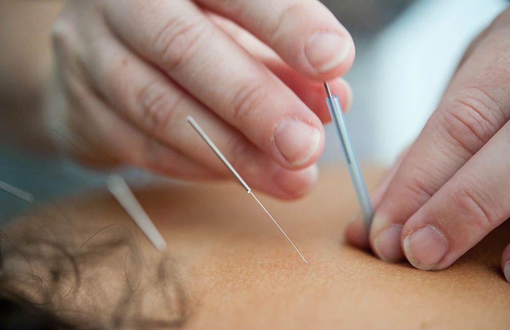 Wat is Dry Needling?